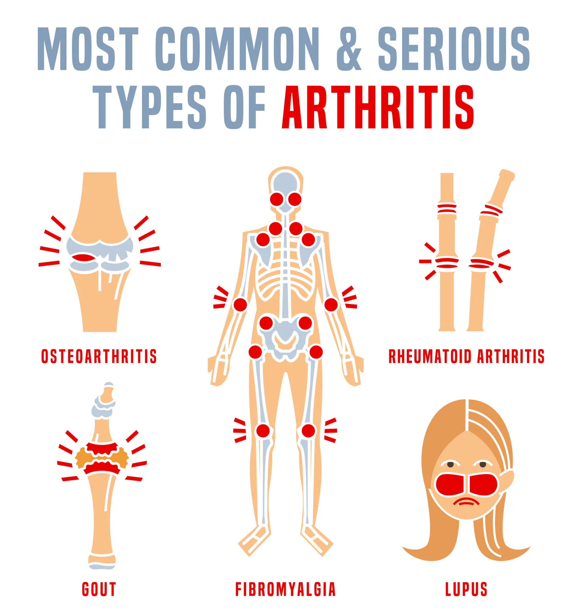 What-Are-the-Types-of-Arthritis